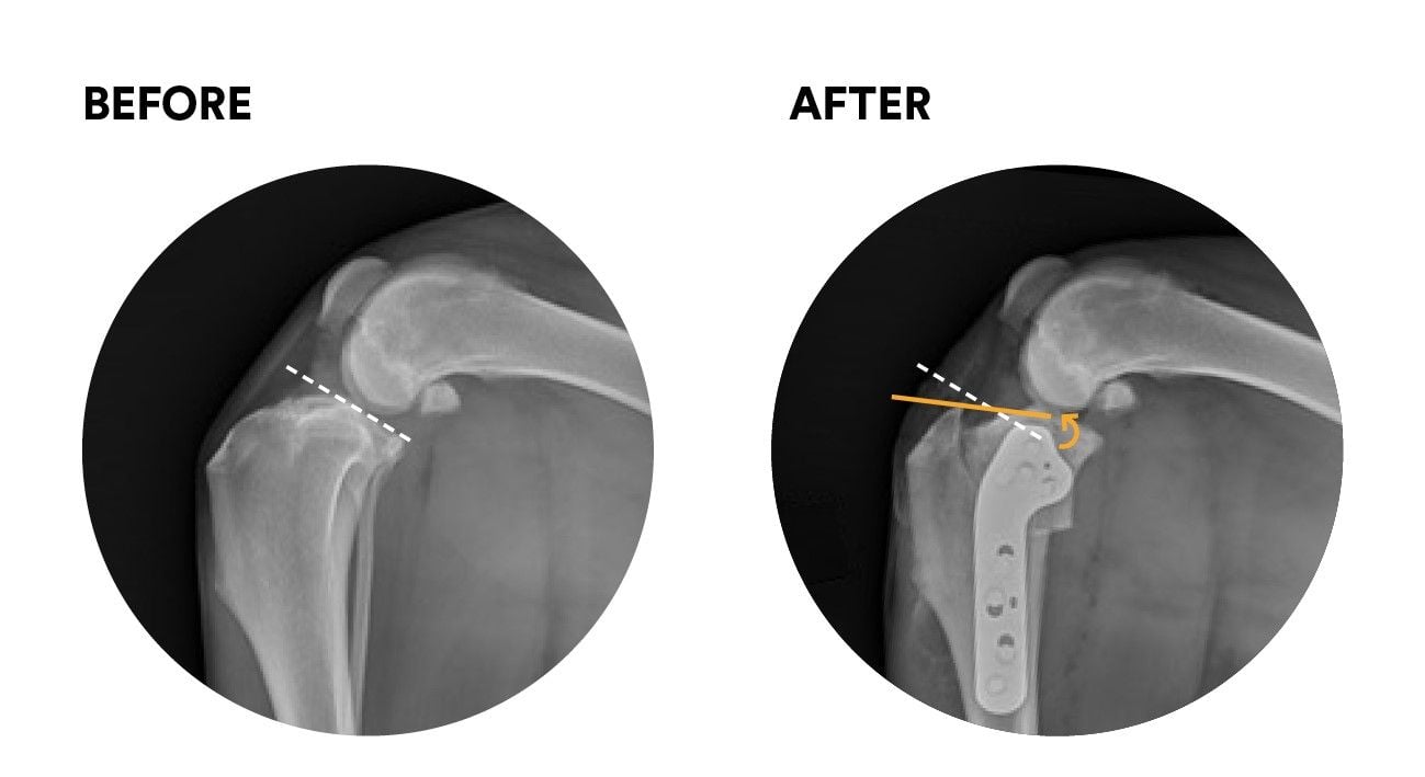 Cruciate Disease and TPLO Surgery Cruciate Disease and TPLO Surgery